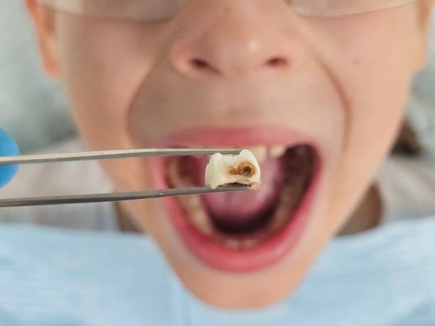 Best Emergency Tooth Extraction in Linda, CA